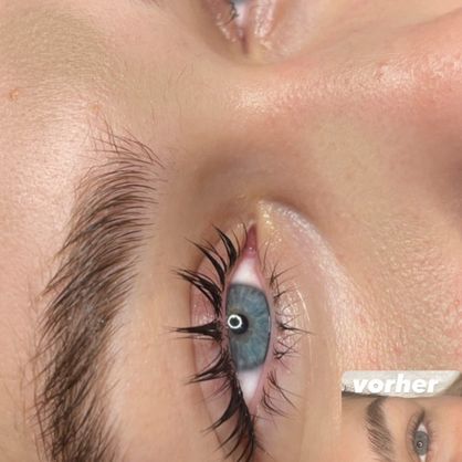 Brow Lifting